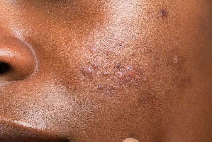 Tache noire sur la peau noire : comprendre, prévenir et atténuer